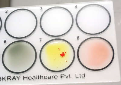 Blood group (B) Negative #